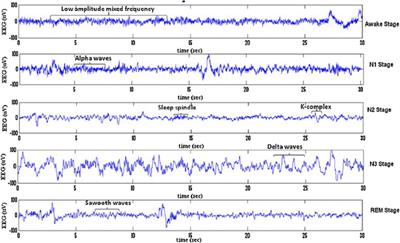 Detection of EEG K-Complexes Using Fractal Dimension of Time Frequency Images Technique Coupled With Undirected Graph Features